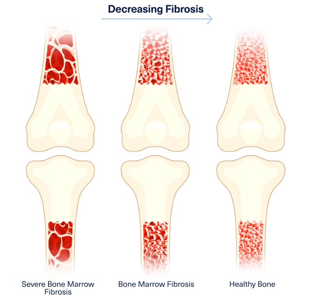 An illustration of 3 bones showing decreasing fibrosis first with severe bone marrow fibrosis then bone marrow fibrosis with healthy bone last